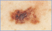 Злокачественная меланома - рак кожи