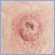 Плоскоклеточная карцинома - рак кожи